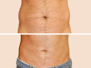 Lipo 1