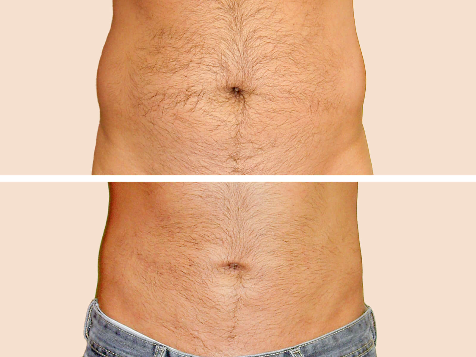 Lipo 1