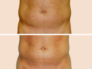 Lipo 2 A