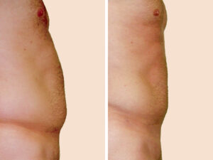Lipo 2 B