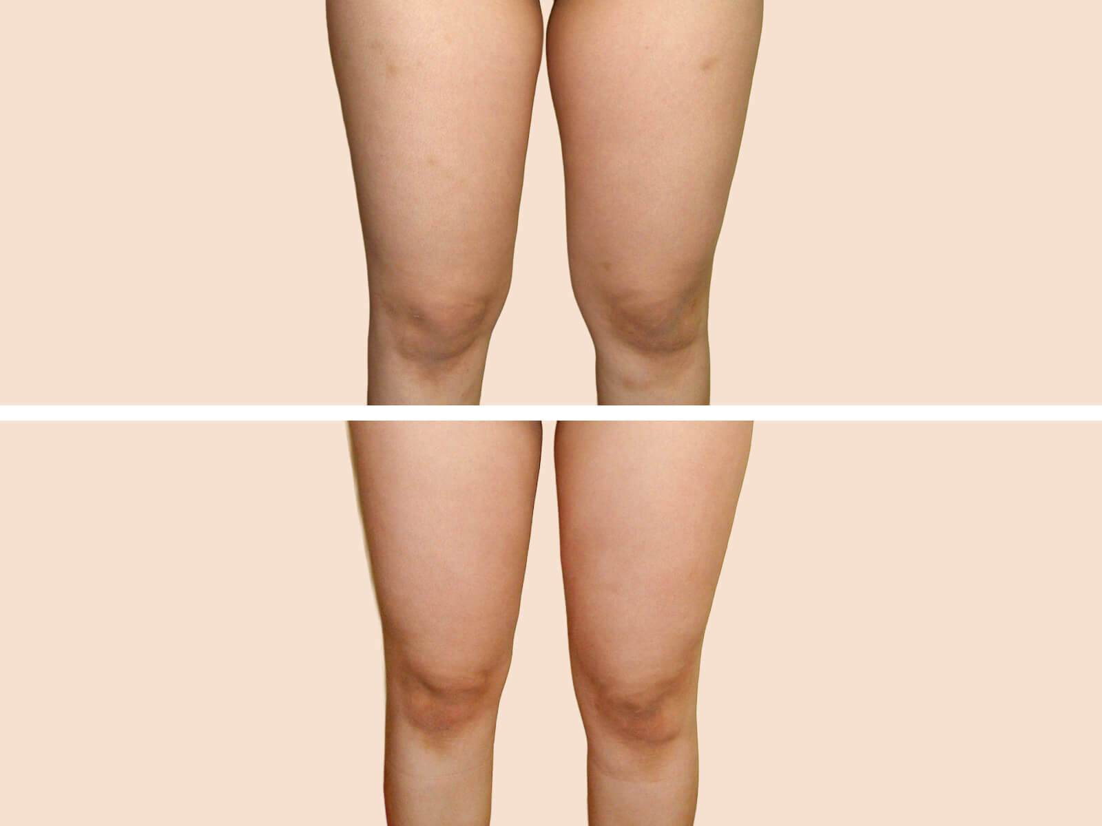 Lipo 4