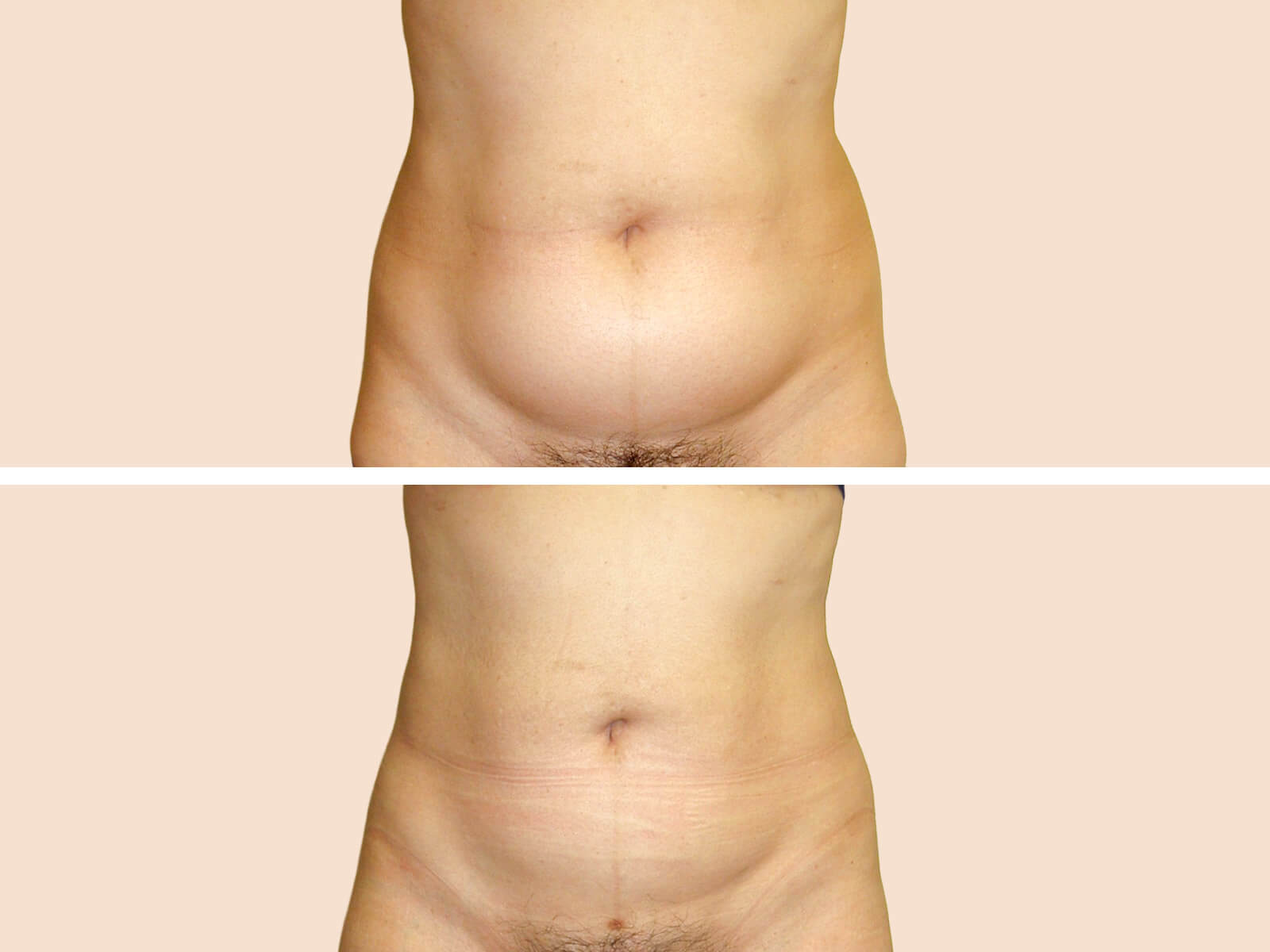 Lipo 5 B