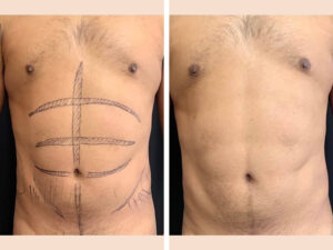 Lipo- INS 1