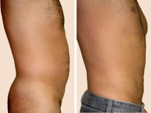 Lipo-1 B