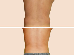 Lipo-1 C