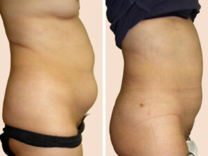Lipo-5 A